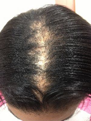 Why is my hair falling out?