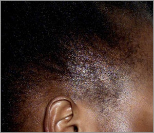 Got a bald patch? You'll want to read this!