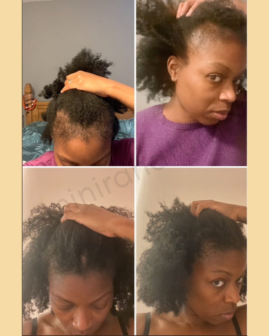 I just CANNOT get over how this product has revived my hair follicles. The bald patch is filling in and I am overjoyed. Through quality products, consistency and patience my crown has been revived. Thanks again Ominira Naturals for giving my tresses the kiss of life!